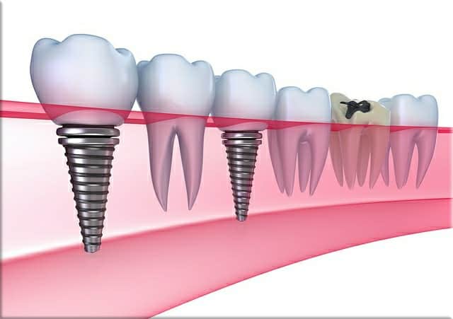 dental implants bellville