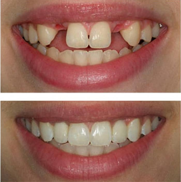 teeth implants bellville