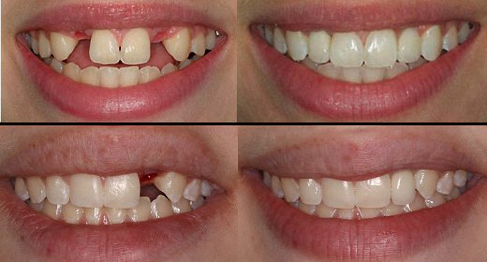 teeth implants brackenfell