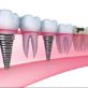 Dental Implants Brackenfell