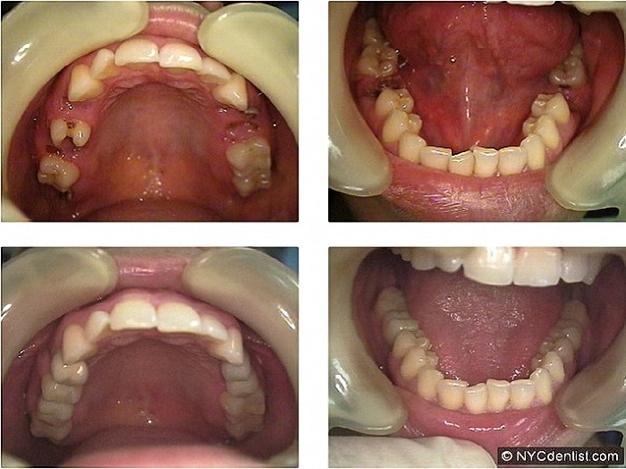 teeth implants durbanville