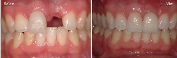 teeth implants kuils river