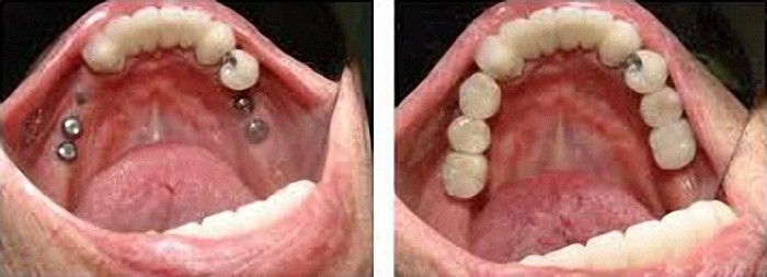 teeth implants somerset west