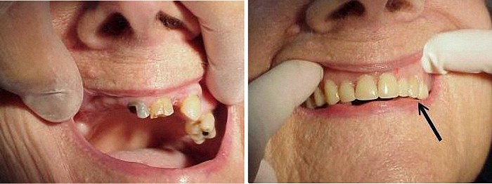 partial dentures durbanville