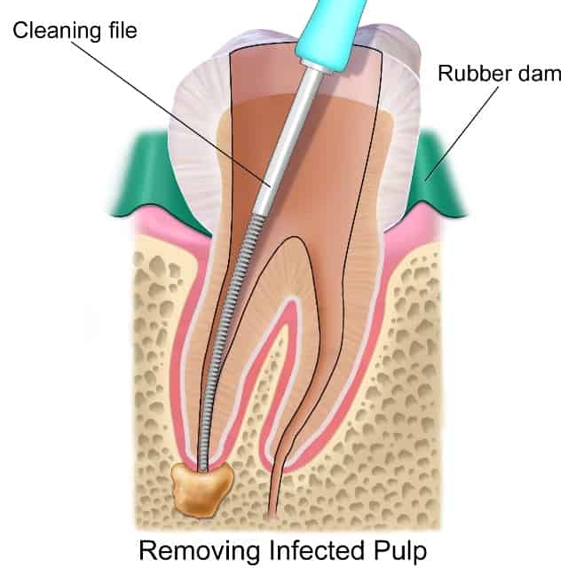 root canal treatment bellville 