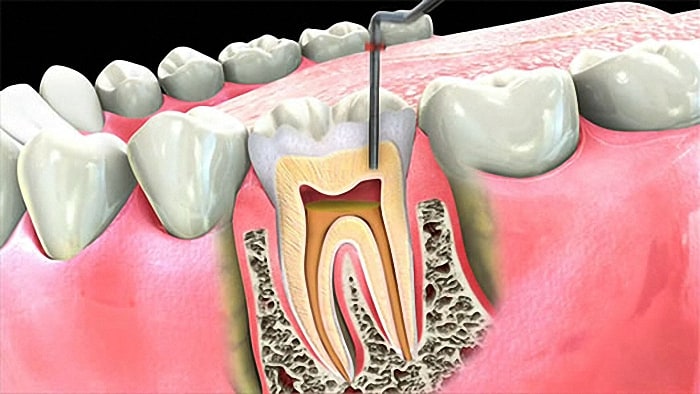 root canal therapy brackenfell