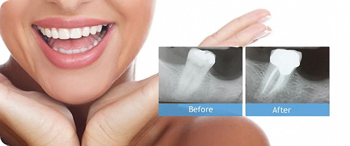 root canal therapy durbanville