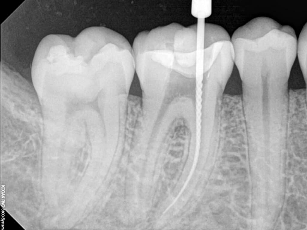 root canal therapy kuils river